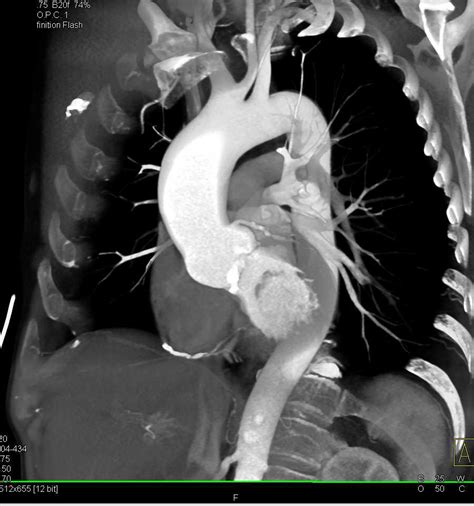 Aortic Valve Leaflet Calcification With Aortic Stenosis Vascular Case