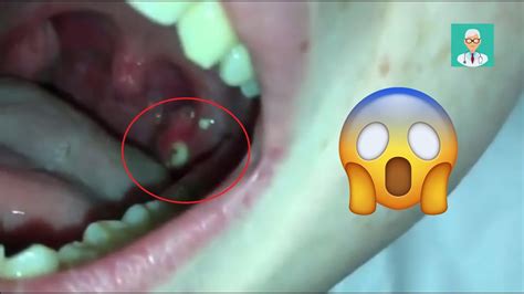 Tonsil Stone Removal By Ent Doctor Medic4arab 😨🔥 Youtube