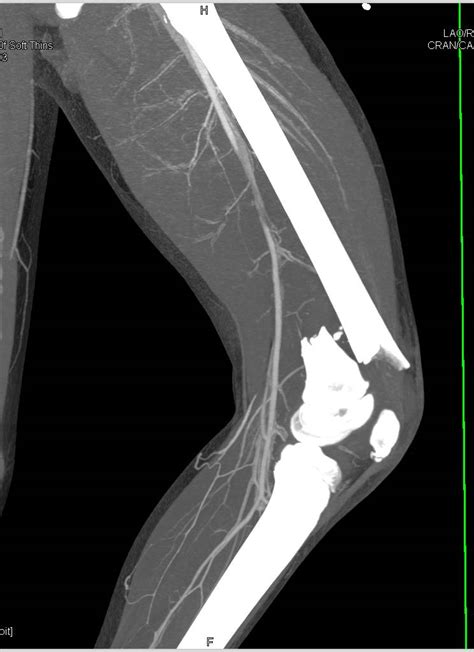 Comminuted Distal Femur Fracture Without Vascular Injury On Cta