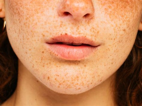Are Freckles On Lips A Cause For Concern Causes Remedies
