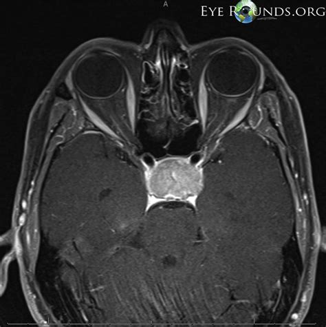 Pituitary Adenoma Causing Compression Of The Optic Chiasm The
