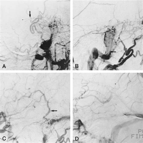 Left External Carotid Arteriograms In Anteroposterior A And Lateral