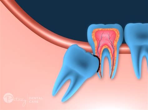 Wisdom Teeth Removal Dentist In Ryde Gladesville And Meadowbank