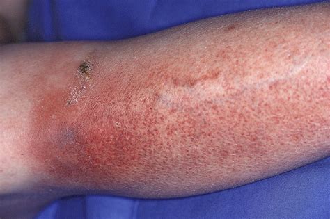Lower Extremity Cellulitis Diagnosed With Increased Accuracy Using Alt