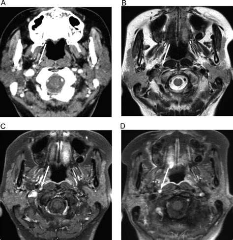 Metastatic Retropharyngeal Lymph Nodes Comparison Of Ct And Mr Imaging
