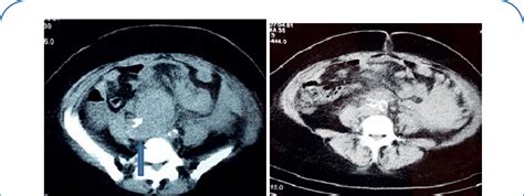 Non Contrast Ct Scan Of Abdomen Showing Ruptured Rciaa With