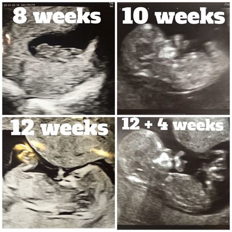 Life Unexpected 12 Weeks Pregnant High Nt Measurement