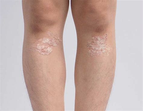 Pediatric Psoriasis Before And After Results Taltz Ixekizumab