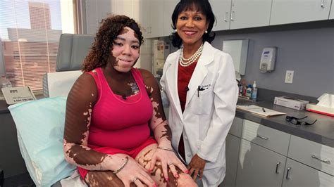 Woman With Vitiligo Undergoes State Of The Art Treatment To Reverse The
