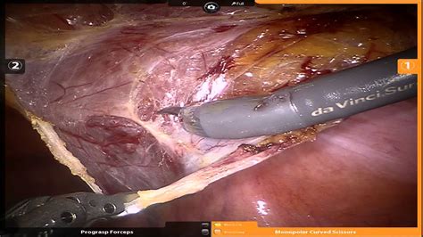 Robotic Repair Of An Incarcerated Right Inguinal Hernia Youtube