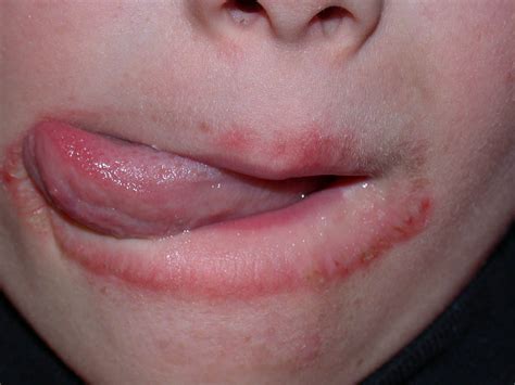 Lip Lickers Dermatitis Causes Symptoms And Treatment