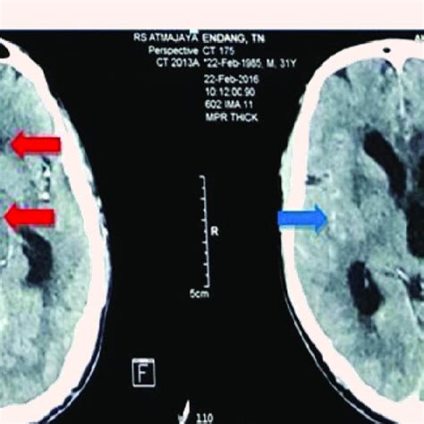 Contrast Enhanced Brain Ct Showed Multiple Hypodense Lesions Red