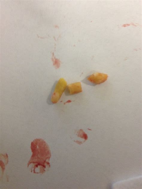 Salivary Gland Stones From My Mouth Popping