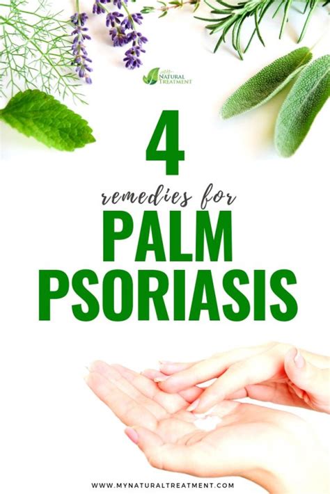 4 Natural Remedies For Palm Psoriasis With Instructions