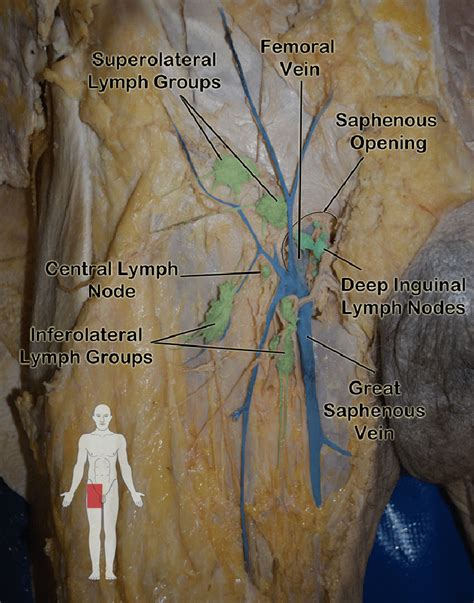 I'm putting up this picture and where the red lines are is where it's affecting me. Cadaveric image of inguinal lymphatics noted on gross ...