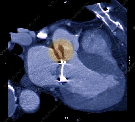 Leaky Mitral Valve Replacement Ct Scan Stock Image C0403410