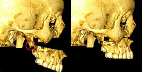 Facial Morphology Changes After Total Maxillary Setback Osteotomy