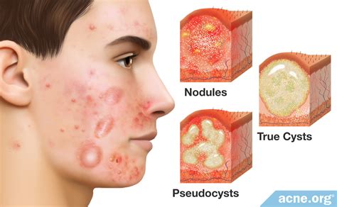 How To Prevent Cystic Pimples Behalfessay