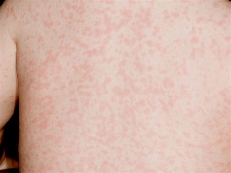 Measles Causes Symptoms And Treatment Health Care Qsota