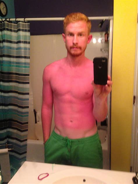 Funny Sunburned People Who Failed To Use Sunscreen