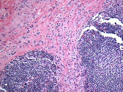 Metastatic Lobular Carcinoma Is Seen Mostly Outside The Lymph Node