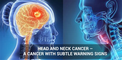 Advanced Treatment For Head And Neck Cancer