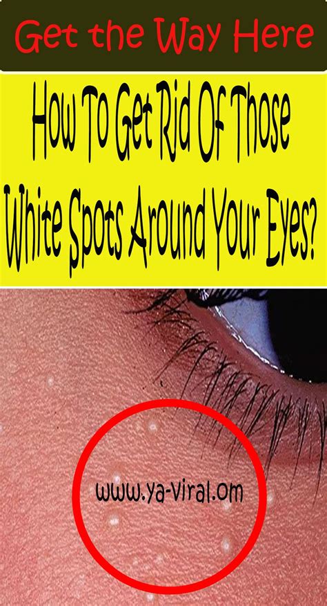 How To Get Rid Of Those White Spots Around Your Eyes Health