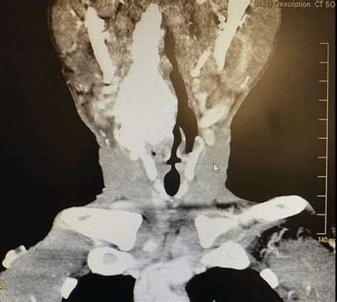 Coronal View Ct Soft Tissue Neck An Amorphous Calcified Soft Tissue