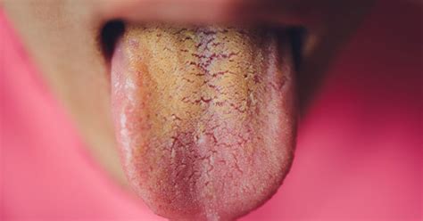Yellow Tongue Causes Symptoms Treatment Diagnosis And Prevention