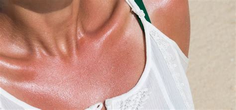 Even One Bad Sunburn Can Cause Skin Cancer Guides
