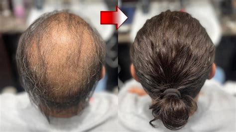These Balding To Long Hair Look Transformations Are Mind Blowing Youtube