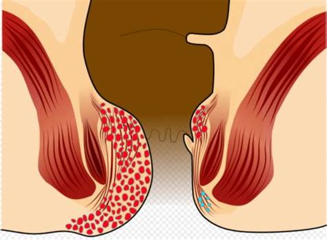 Thrombosed piles are also called thrombosed haemorrhoids and they can be very painful. Do Hemorrhoids Go Away on Their Own? | IYTmed.com