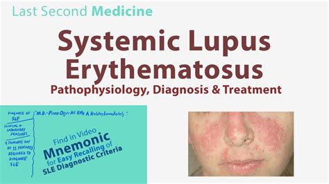 Systemic Lupus Erythematosus Sle Pathophysiology Diagnosis Diagnostic Criteria
