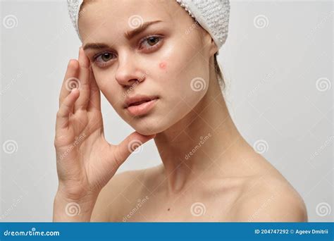 Attractive Woman With Towel On Head Naked Shoulders Pimples On Face