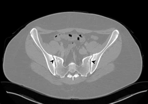 An Omitted Radiological Finding In The Pediatric Age Group Physiological Sacroiliac Joint