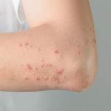 Pictures of Doctor For Skin Rash