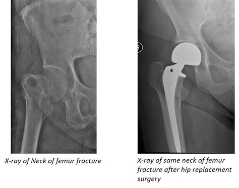 Osteoporotic Hip Fracture
