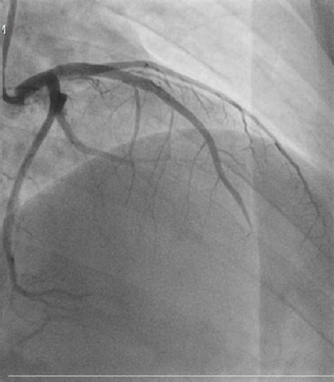 Coronary Angiography Lao Cranial View Showing Good Flow In Lad After
