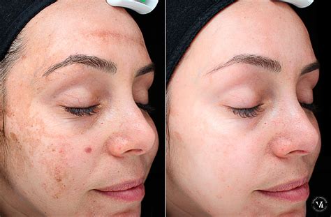 Chemical Peels Before And After Photo Gallery
