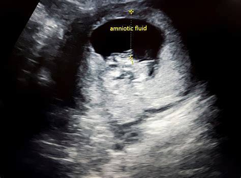 Amniotic Fluid Infection Noredurl