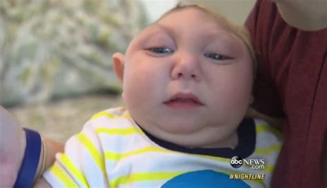 無脳症の赤ちゃんが1年間生存することができたという奇跡 バイオハックch