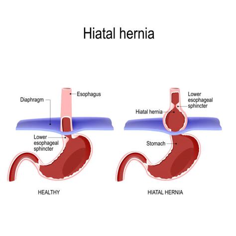 Hernia Stock Photos Pictures And Royalty Free Images Istock