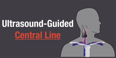Ultrasound Guided Central Line Placement Made Easy Step By Step Guide
