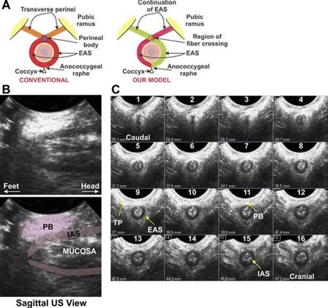 purse string morphology of external anal sphincter revealed by novel imaging techniques