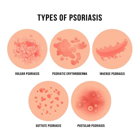 psoriasis understanding the condition and treatment options thepurepulse
