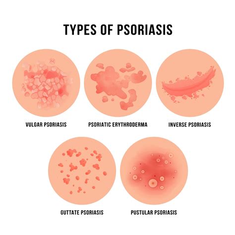 Psoriasis Understanding The Condition And Treatment Options Thepurepulse