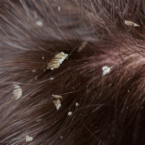 The Itchy Facts About Dandruff - GetHair