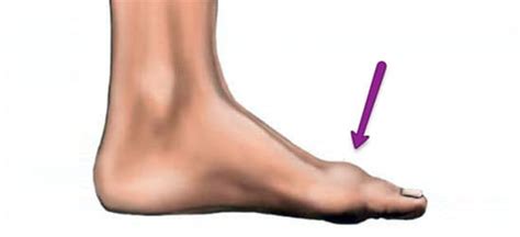 They usually occur after an acute injury although repetitive forced upward movement of the great toe may also lead to an injury of the tissue. Turf Toe, Big Toe Joint Pain
