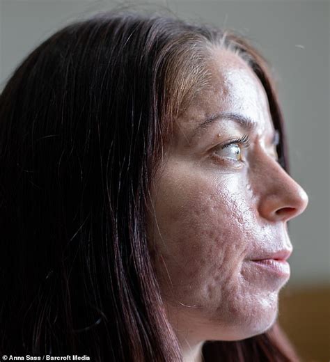 Personal Trainer Who Had The Worst Acne Ever Seen Shares Her Striking Before And After