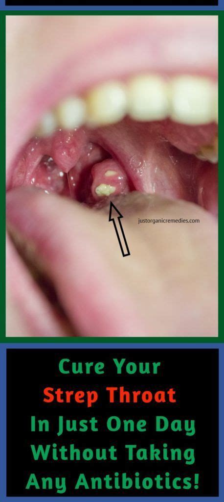 12 Effective Natural Home Remedies To Treat A Strep Throat Infection Strep Throat Throat